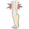 Treatment of Fractures & Trauma